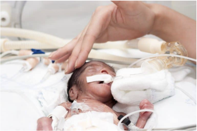 What-is-Respiratory-Distress-Syndrome-RDS-in-a-newborn