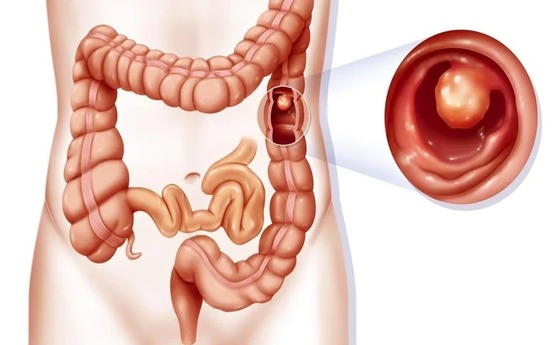 10 Symptoms of intussusception You Should Never Ignore